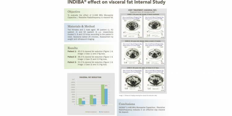 Case Study Highlights INDIBA 448 kHz Radiofrequency’s Role in Visceral Fat Reduction and Prevention of Fat Accumulation